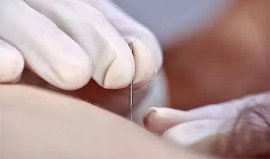 Dry Needling