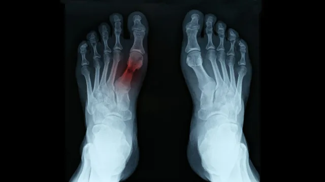THE SILENT STRAIN: UNDERSTANDING STRESS FRACTURES IN THE FOOT